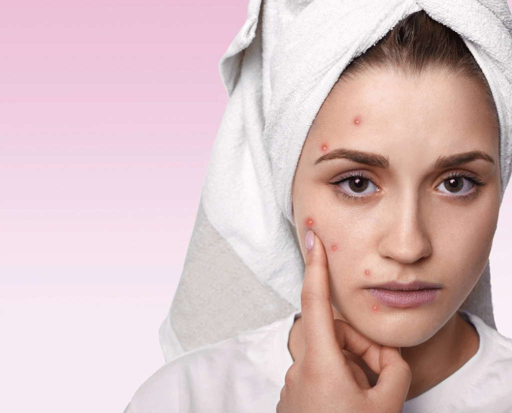 Young woman with visible acne on her face, touching blemishes while looking concerned, representing the need for effective acne treatment solutions.