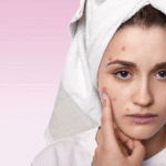 Young woman with visible acne on her face, touching blemishes while looking concerned, representing the need for effective acne treatment solutions.