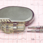 Close-up of a pacemaker device and its leads placed on an ECG printout, illustrating modern pacemaker technology used to regulate heart rhythm.