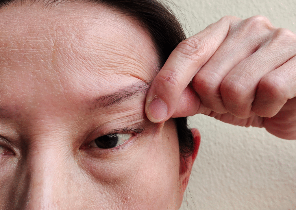Close-up of a person pulling up their upper eyelid to show loose, sagging skin and fine wrinkles around the eye area, indicating potential for eyelid surgery.