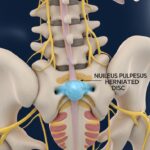 Herniated Disc: A Complete Guide to Its Treatment