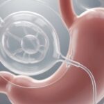 An image showing a realistic depiction of a gastric balloon inside a human stomach, illustrating the procedure which can be a consideration when researching gastric balloon cost.