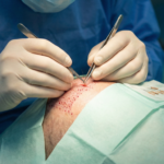 Close-up view of a Follicular Unit Extraction (FUE) hair transplant procedure, showing a surgeon implanting individual grafts into the scalp.
