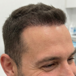 Successful hair transplant surgery results showing a dense, natural restored hairline after an FUE or DHI procedure.