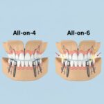 Detailed diagram comparing the placement of All-on-4 dental implants (four posts) and All-on-6 dental implants (six posts) in the jawbone, illustrating the structural differences for full-arch solutions.