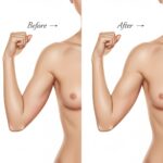 Illustration of an upper arm before and after arm liposuction, showing targeted fat removal and a resulting toned contour.