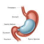 Medical diagram illustrating how an inflated gastric balloon works inside the stomach to promote satiety and aid in non-surgical weight loss.