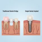 Diagram comparing a traditional dental bridge supported by adjacent teeth and a dental implant replacing a missing tooth root.