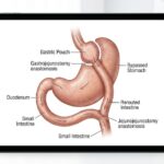 A medical diagram illustrating the laparoscopic gastric bypass procedure for weight loss.
